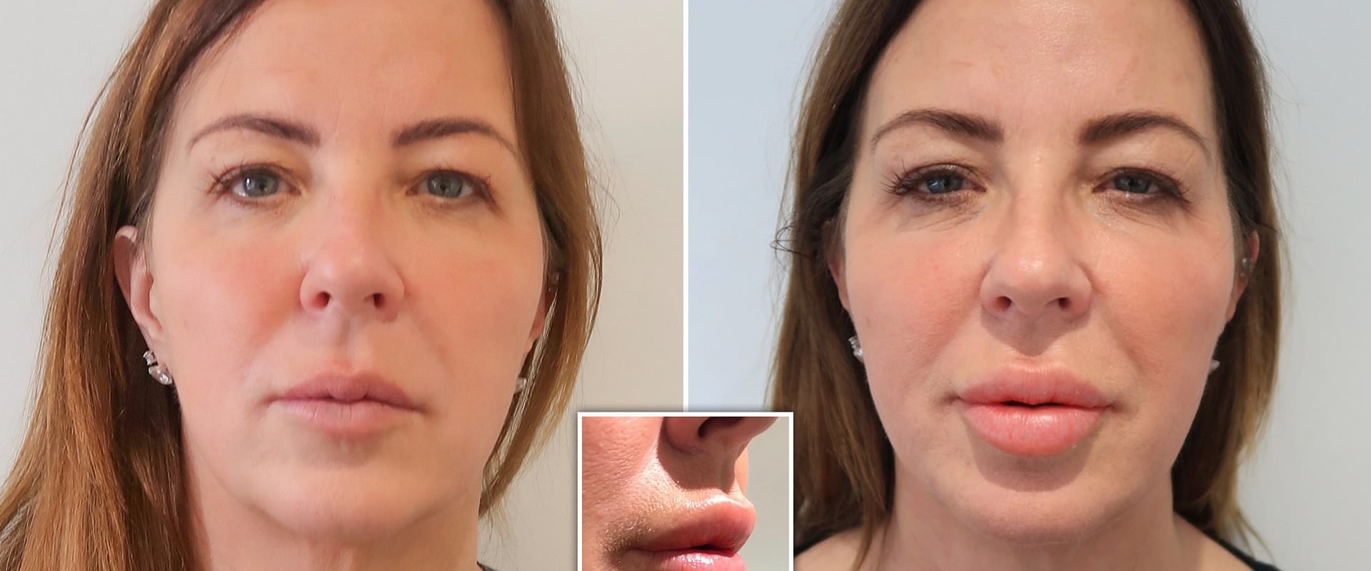 What happens after years of lip injections?