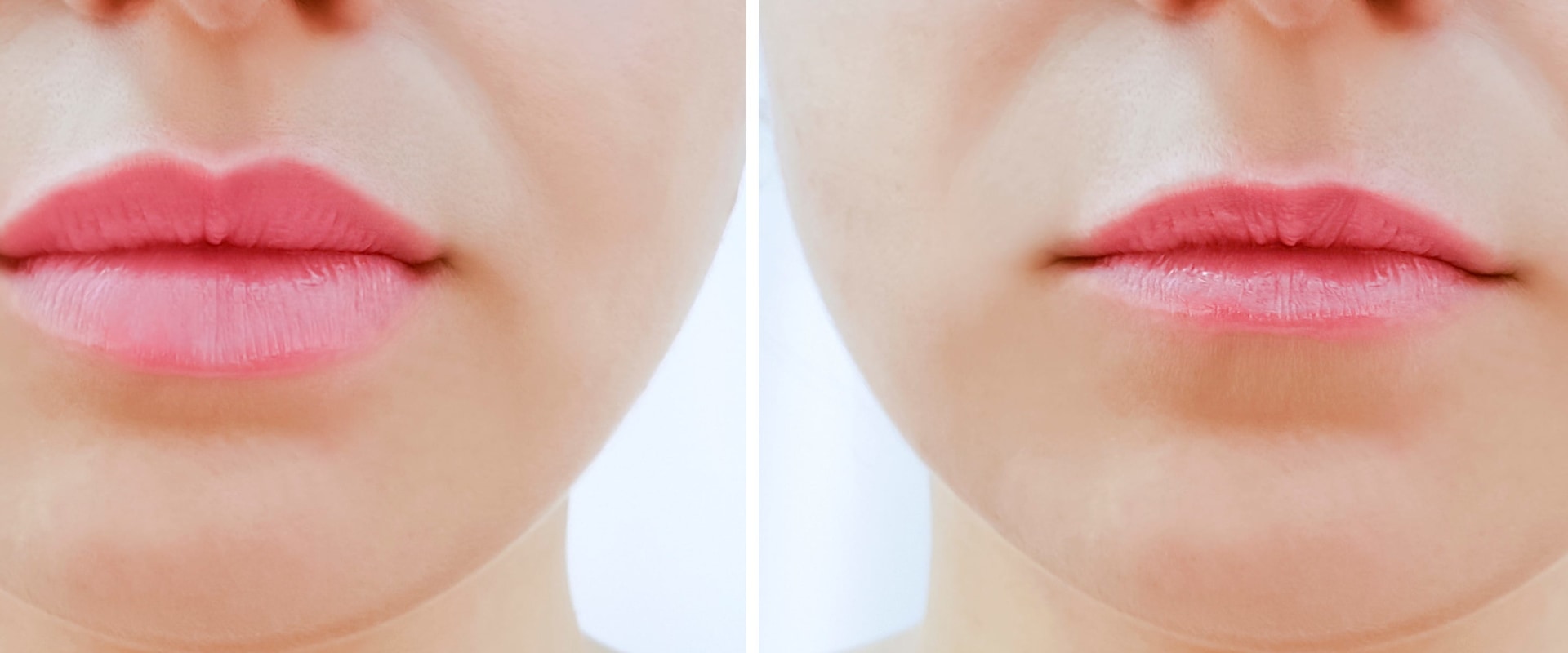 How Much Do Lip Fillers Cost for Lips?