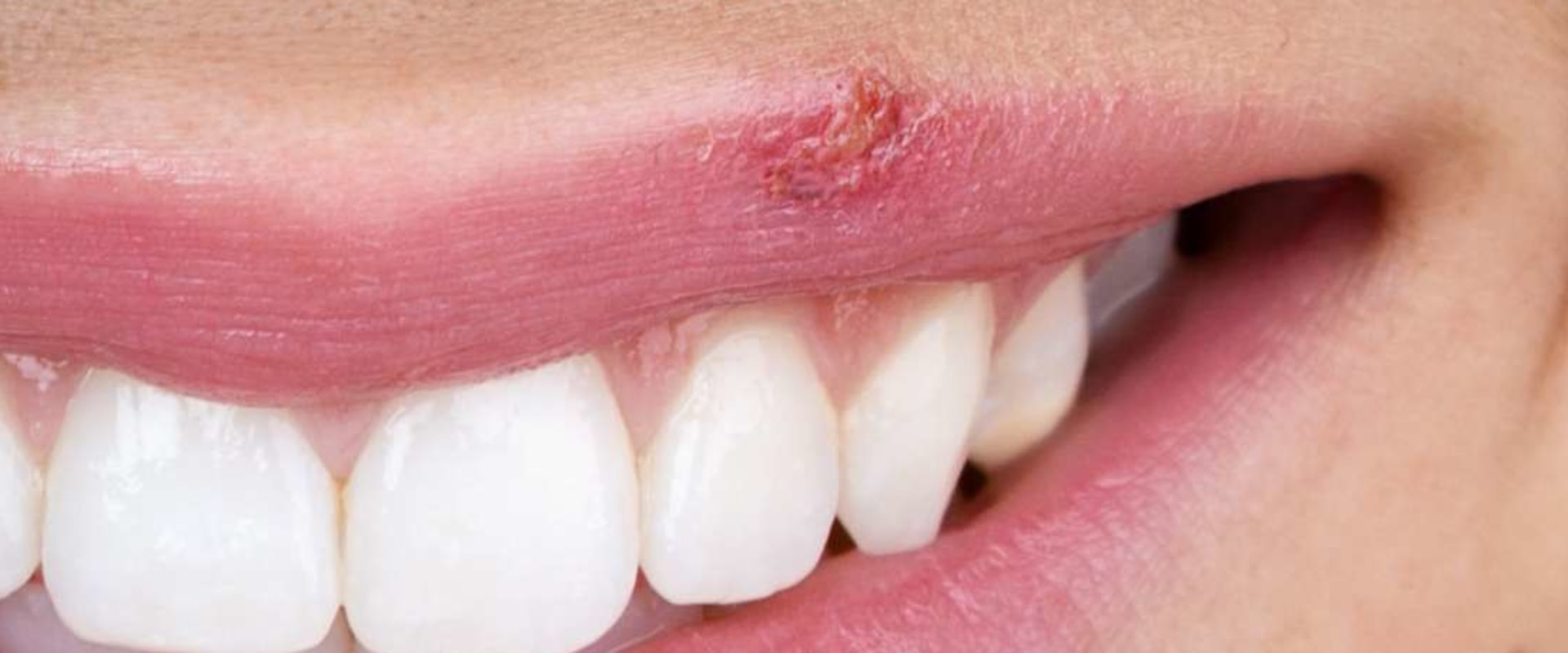 Can Lip Injections Cause Cold Sores?