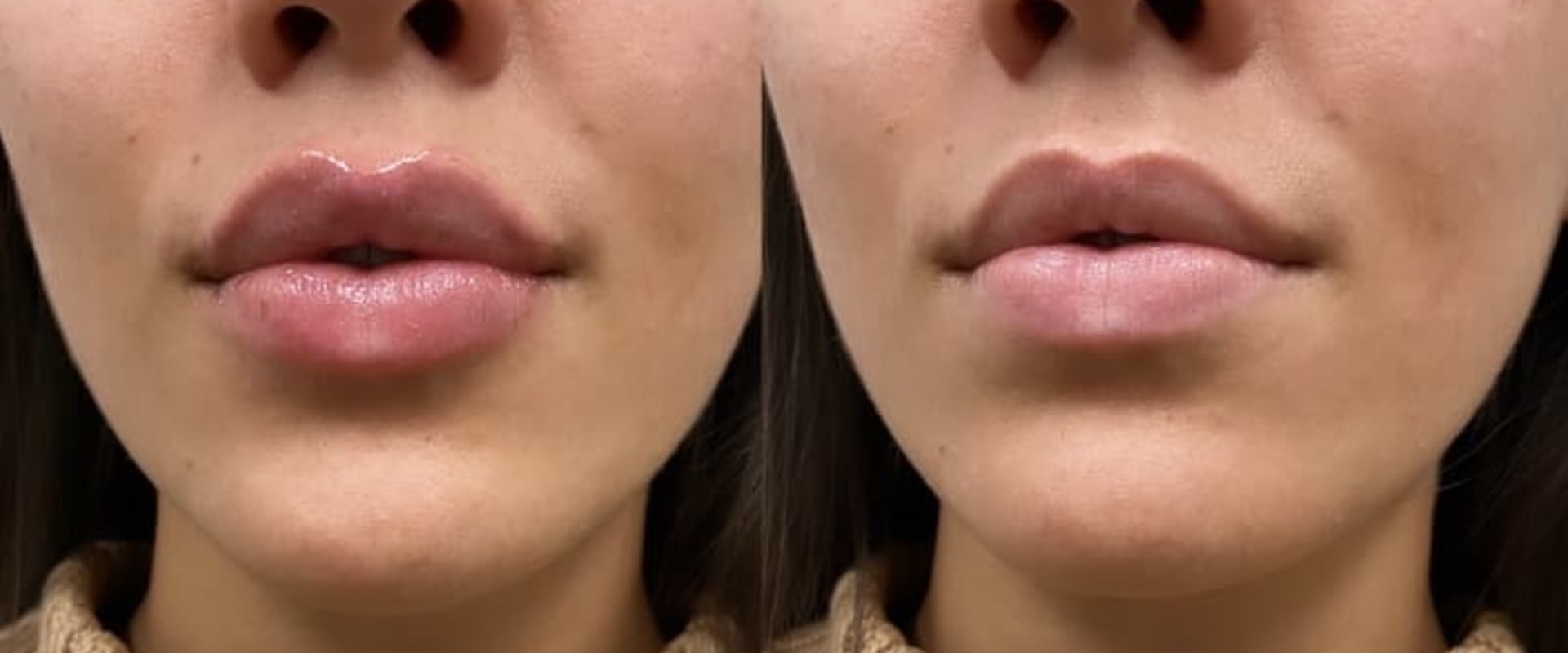 Lip Injections Near Me Get the Best Results with Juvederm