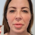 What happens after years of lip injections?