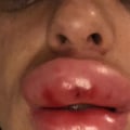 Are lip injections painful?