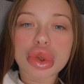 Why are my lip injections lumpy?