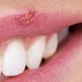 Can Lip Injections Cause Cold Sores?