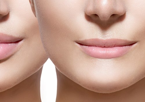 What is most popular lip filler?