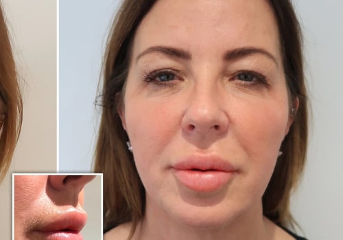 What Happens After Years of Lip Injections?