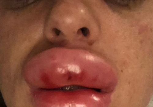 Are lip injections painful?