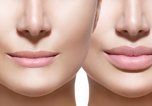 Lip injections for Fuller Lips by Curated Medical