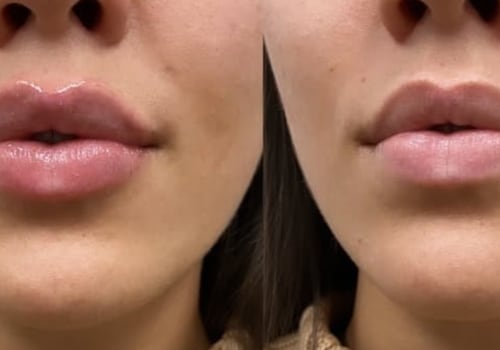 How much are lip injections near me?