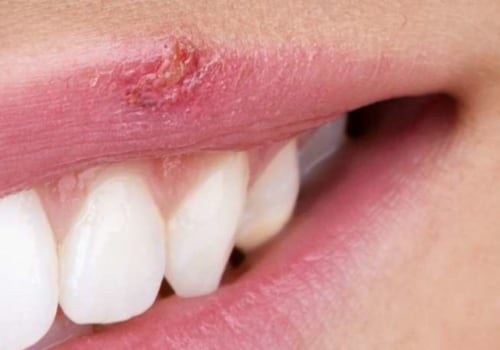 Why Lip Injections Can Trigger Cold Sores