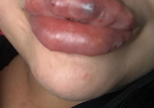Does lip injections hurt?