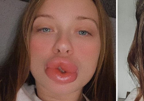 Why are my lip injections lumpy?