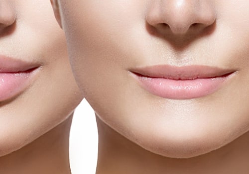 What is the Best Lip Filler for Lips?