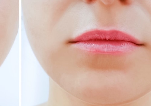 How much are lip injections in nyc?